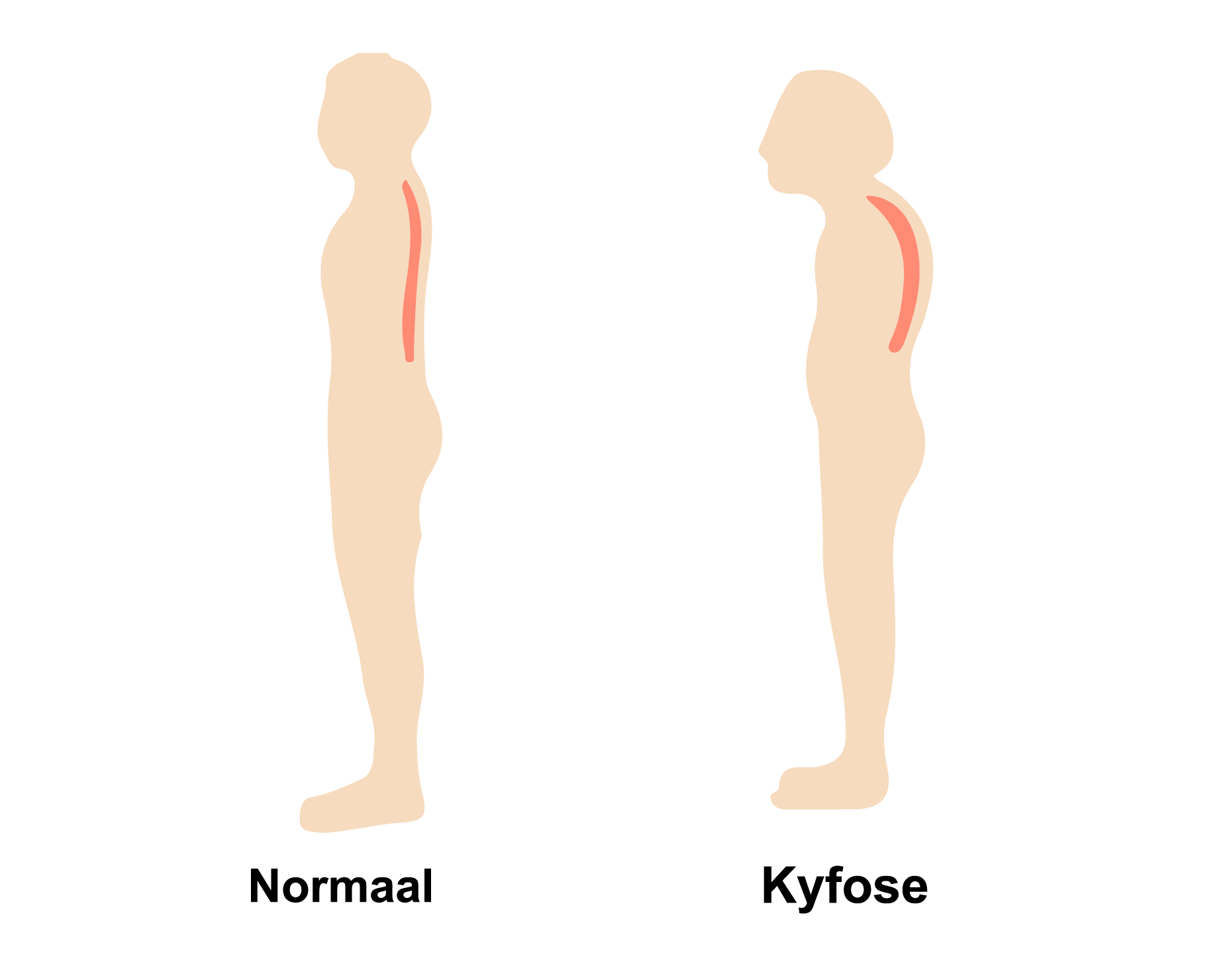 Normaal - Kyfose